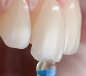 تركيبات الأسنان