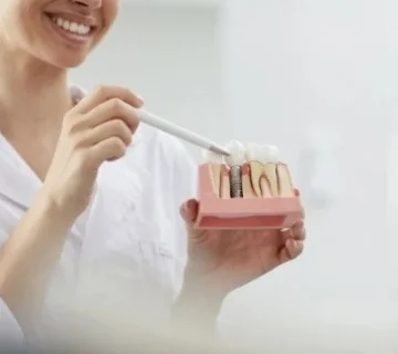 عيادة ماريز لطب الاسنان زراعة الأسنان