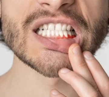 جراحة اللثة