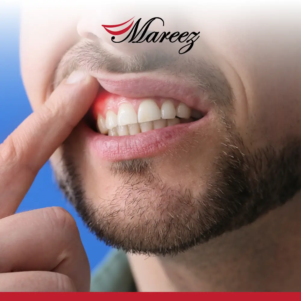 أسباب نزيف اللثة بعد النوم لماذا يحدث نزيف اللثة بعد النوم؟