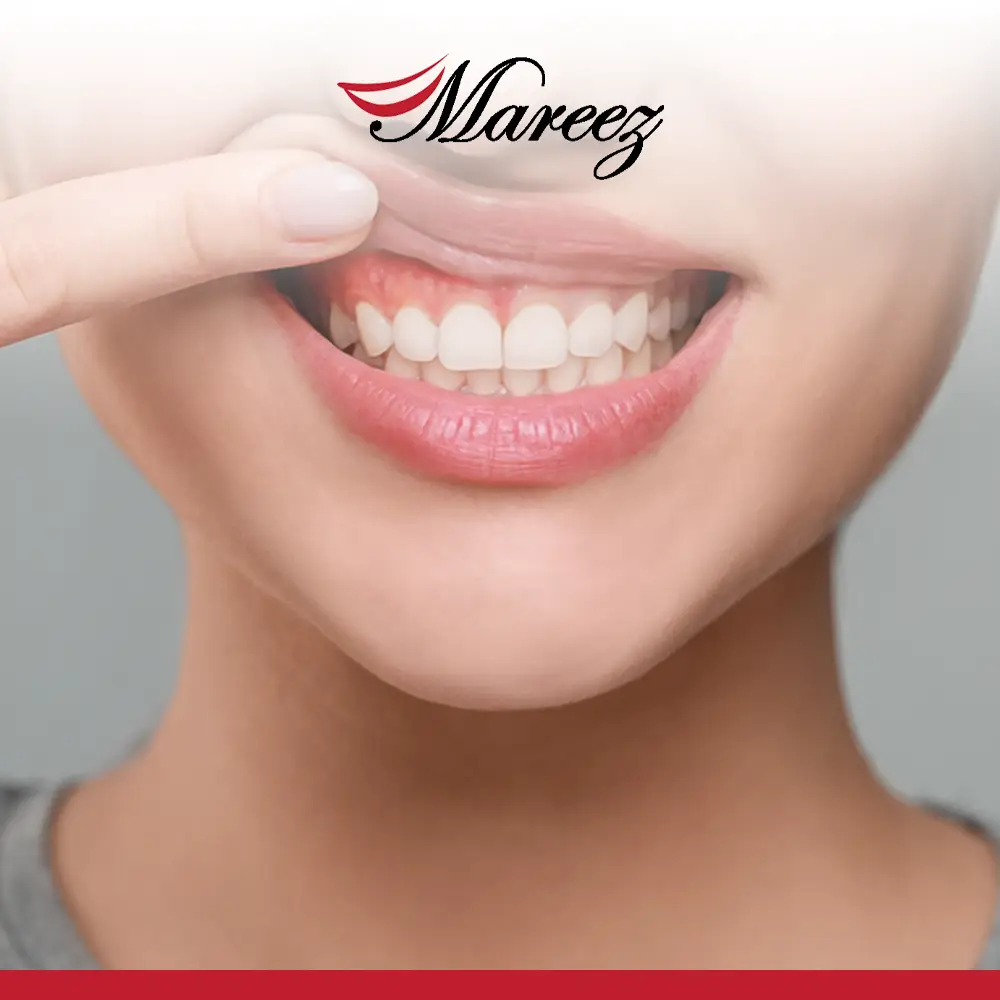 أفضل طريقة لعلاج اللثة الملتهبة كم يستغرق علاج التهاب اللثة للتعافي بشكل كامل؟