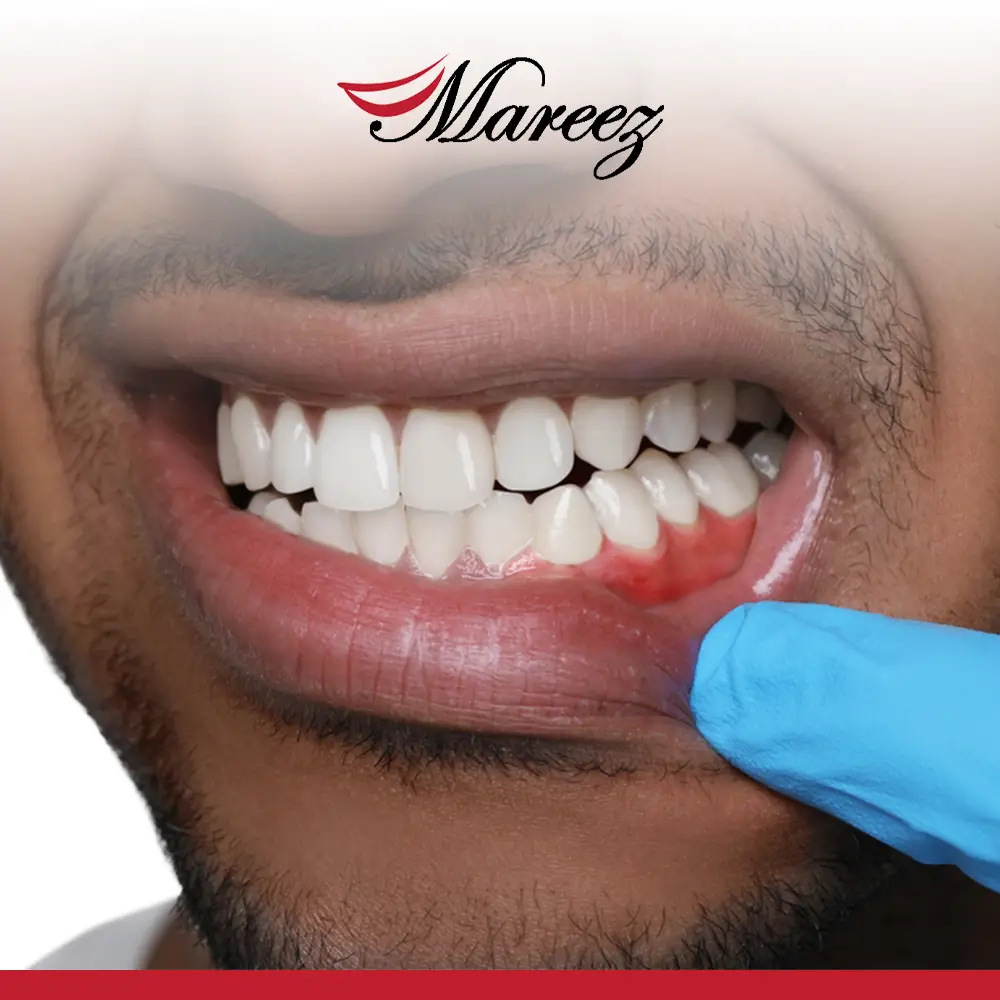 أفضل طريقة لعلاج اللثة الملتهبة ما هي أفضل طريقة لعلاج اللثة الملتهبة بشكل نهائي؟