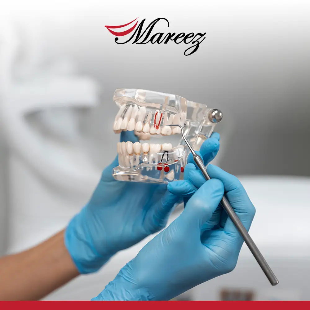 أفضل عيادة زراعة أسنان في جدة لماذا يجب عليك زراعة الأسنان في جدة عبر عيادة ماريز