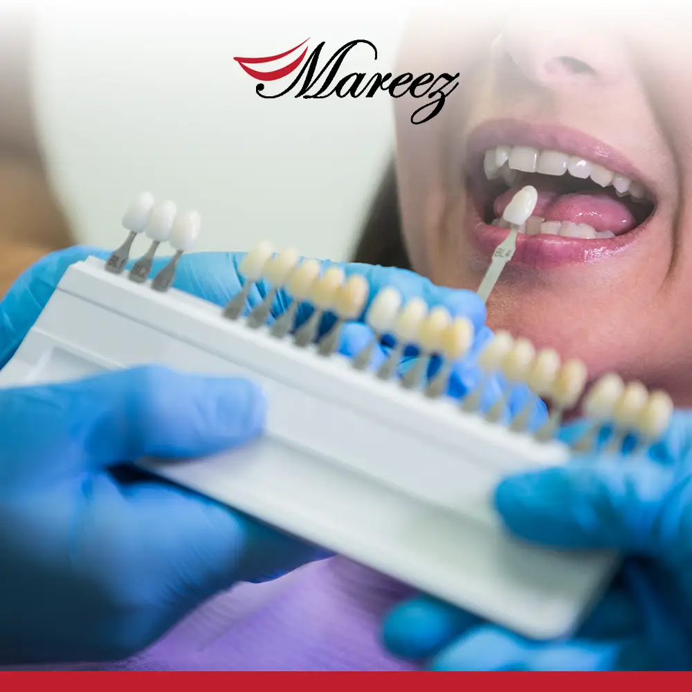 أنواع الأسنان التركيب وأسعارها متى يجب عليك تركيب الأسنان الثابتة؟