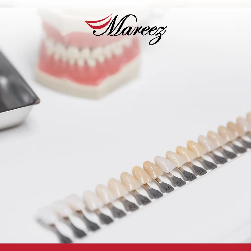 أنواع الأسنان التركيب وأسعارها اكتشف ما هي أنواع تركيبات الأسنان وأفضلها!