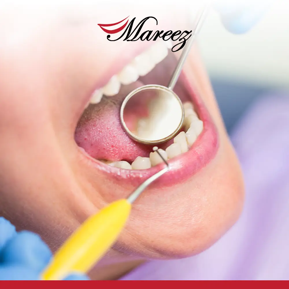 أنواع حشو الأسنان وأسعارها كيف تختار من بين أفضل أنواع حشوات الأسنان؟