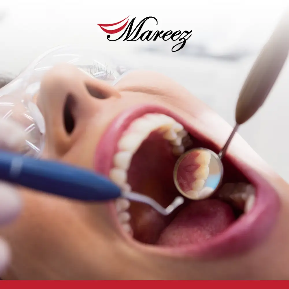 أنواع حشو الأسنان وأسعارها ما هي العوامل المؤثرة على أنواع حشو الأسنان وأسعارها؟