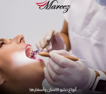 أنواع حشو الأسنان وأسعارها