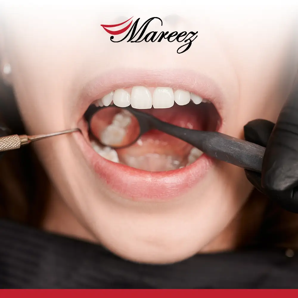 أنواع حشو الأسنان وأسعارها كم تبلغ تكلفة حشو الأسنان في عيادة ماريز؟