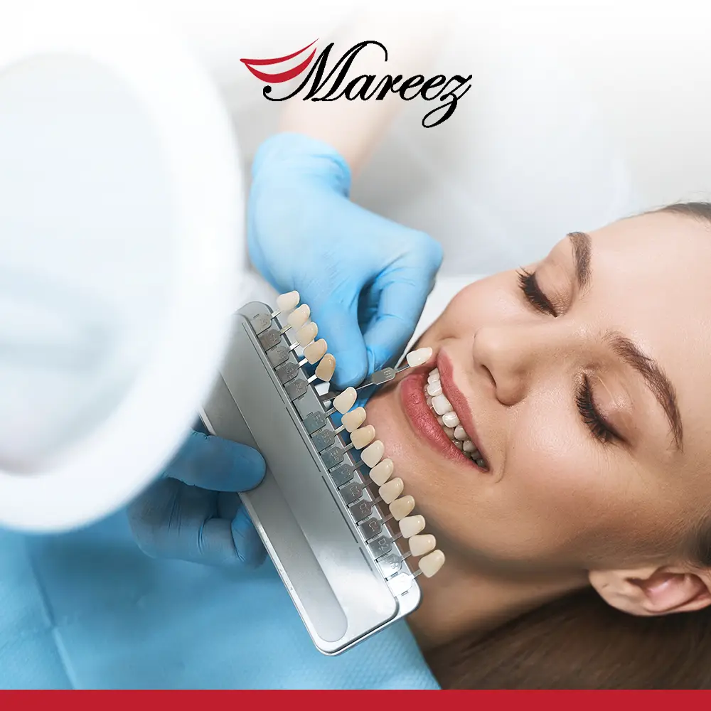 تجميل الأسنان الأمامية بالفينير ما هي تقنية تجميل الأسنان بالفينير