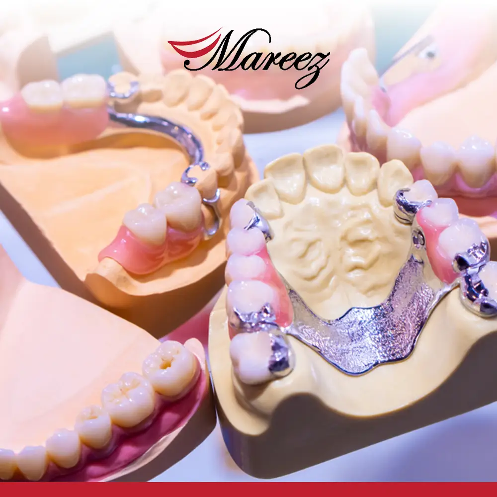 تركيبة أسنان متحركة تجميلية متى يفضل اختيار تركيبة الأسنان المتحركة بدلًا من الثابتة؟