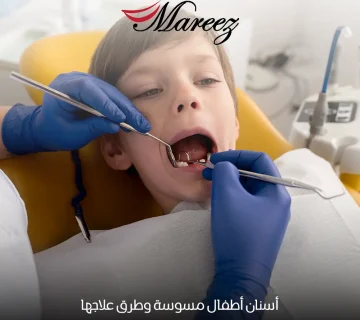 أسنان أطفال مسوسة