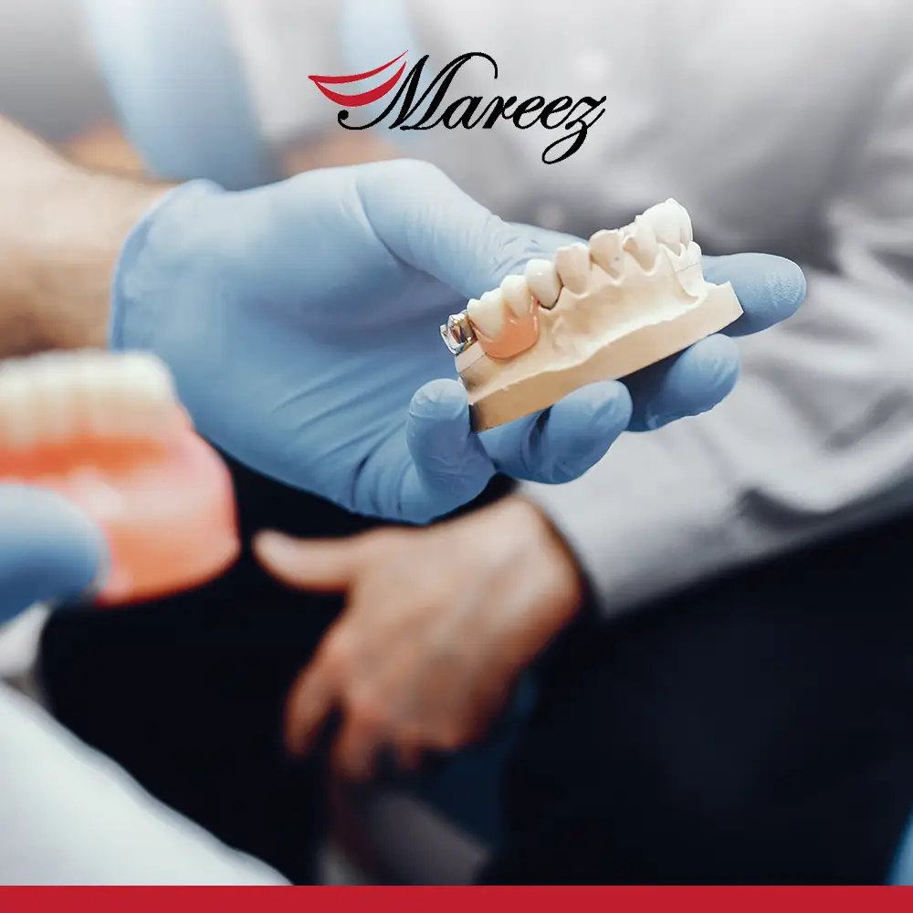 أفضل أنواع جسور الأسنان هل تركيب جسر الأسنان مؤلم؟