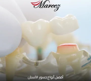 أفضل أنواع جسور الأسنان