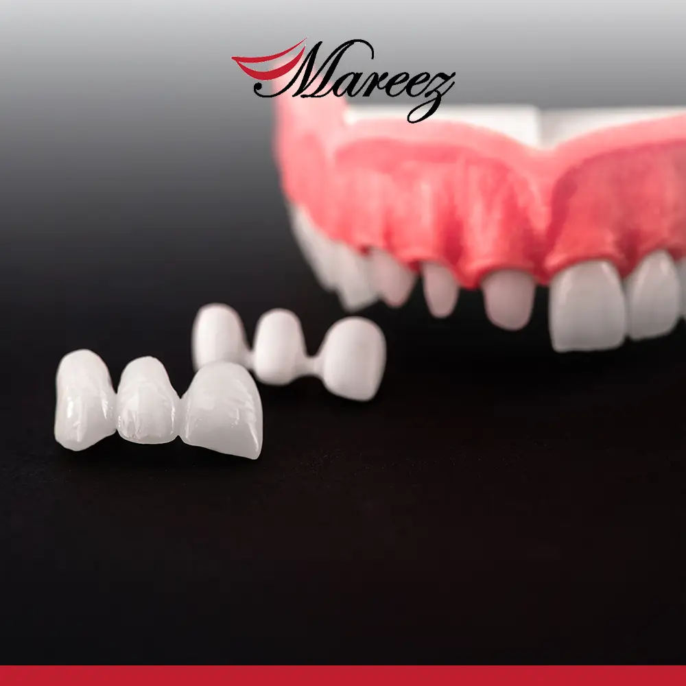 أفضل أنواع جسور الأسنان كم يدوم جسر الأسنان وما هي العوامل المؤثرة عليه؟