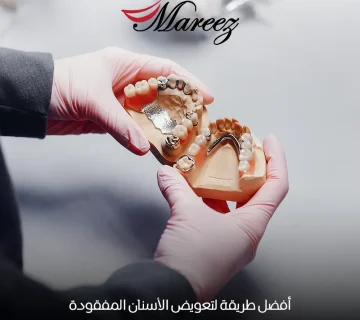 أفضل طريقة لتعويض الأسنان المفقودة