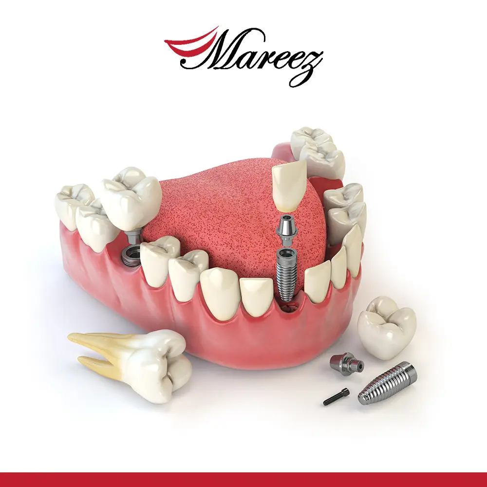 أفضل طريقة لتعويض الأسنان المفقودة كيف تساعد عيادة ماريز في تعويض السن المفقود؟