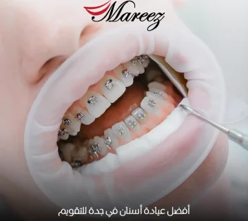 أفضل عيادة أسنان في جدة للتقويم