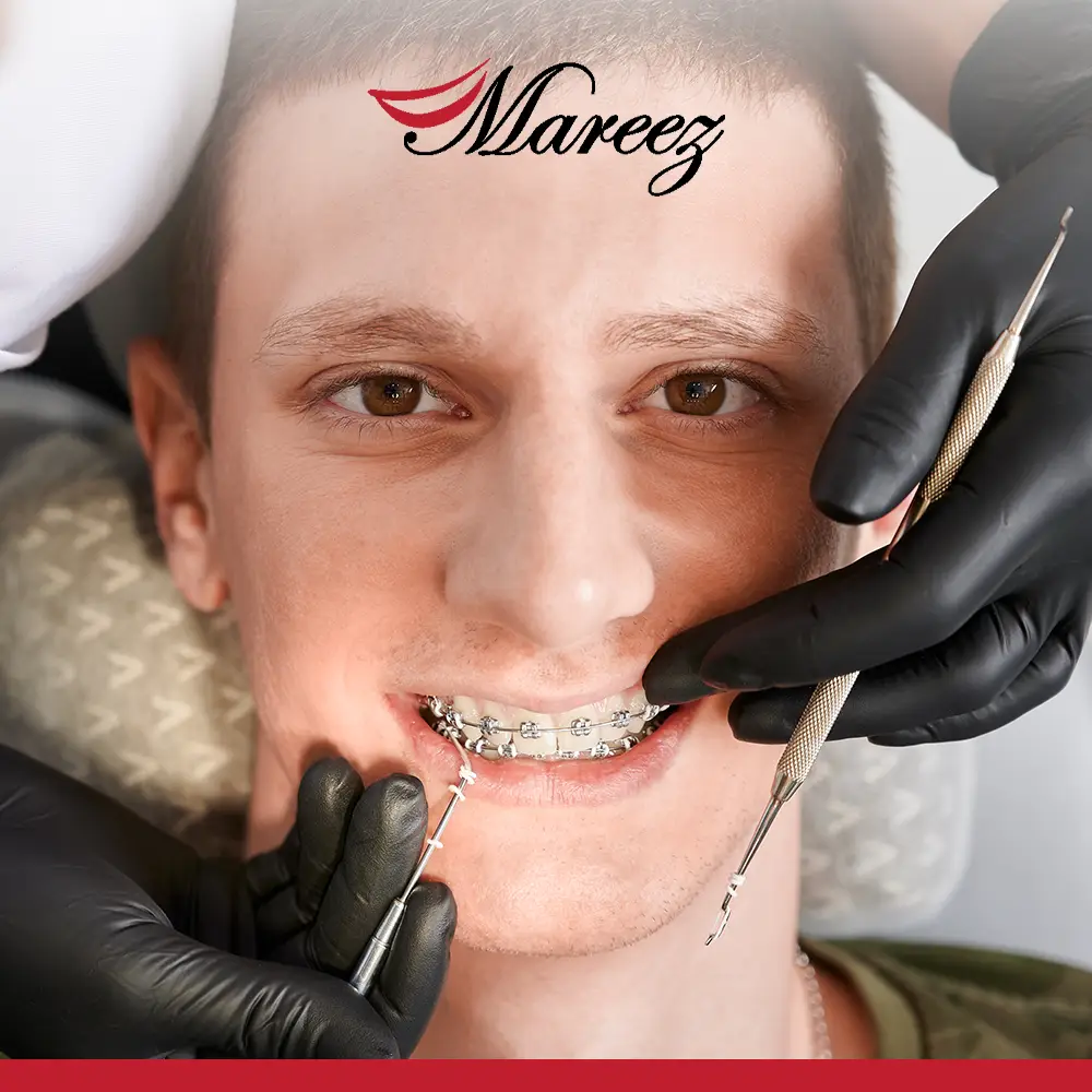 أفضل عيادة أسنان في جدة للتقويم التقويم الداخلي