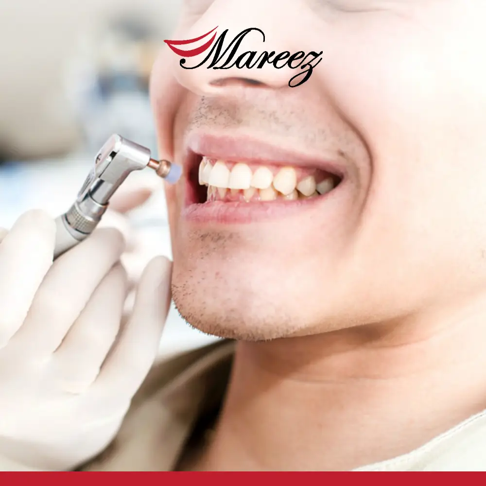 الفرق بين تبييض وتلميع الأسنان