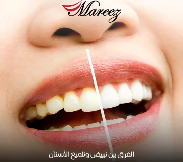 الفرق بين تبييض وتلميع الأسنان