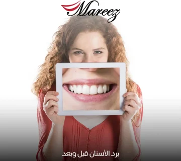 برد الأسنان قبل وبعد