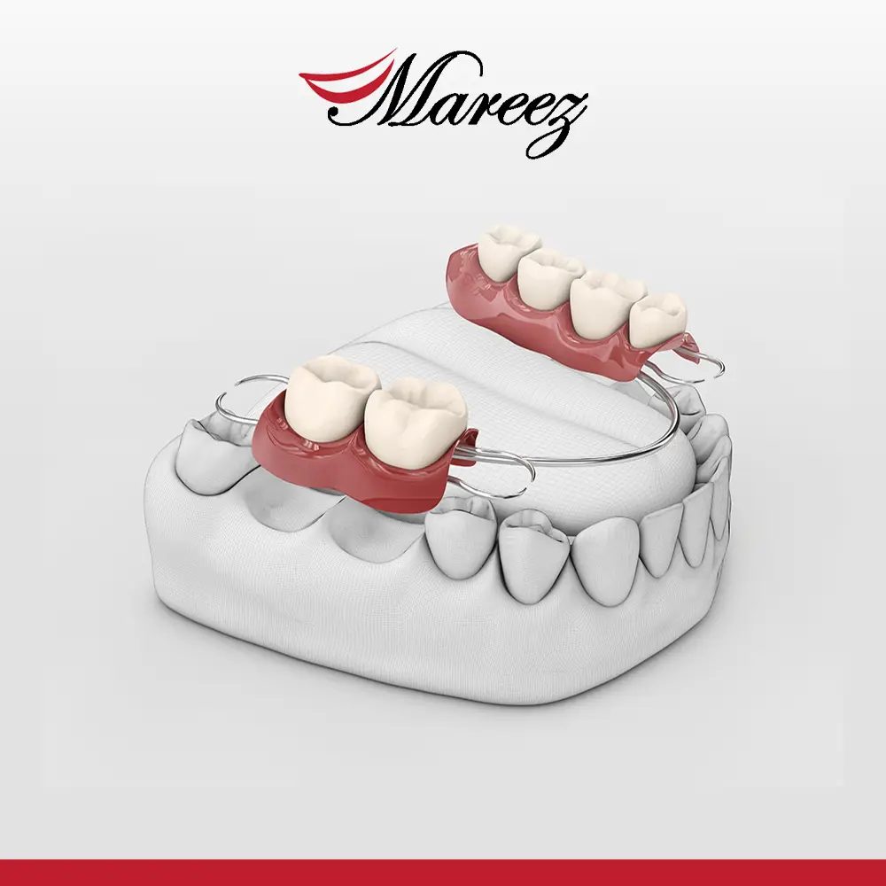 تركيب سن واحد متحرك كيف يمكن تركيب ضرس متحرك بأفضل الطرق؟ 