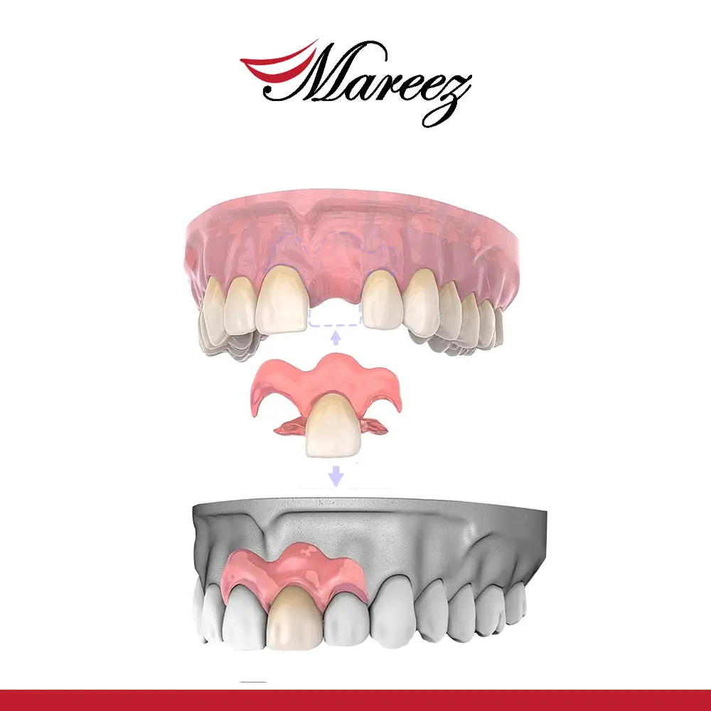 تركيب سن واحد متحرك ما هي أنواع تركيبات الأسنان المتحركة لدى عيادة ماريز؟