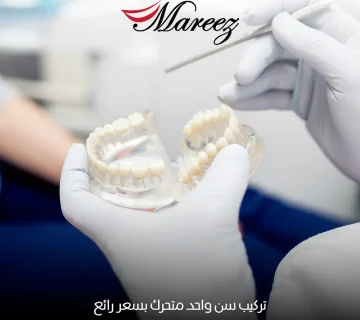 تركيب سن واحد متحرك