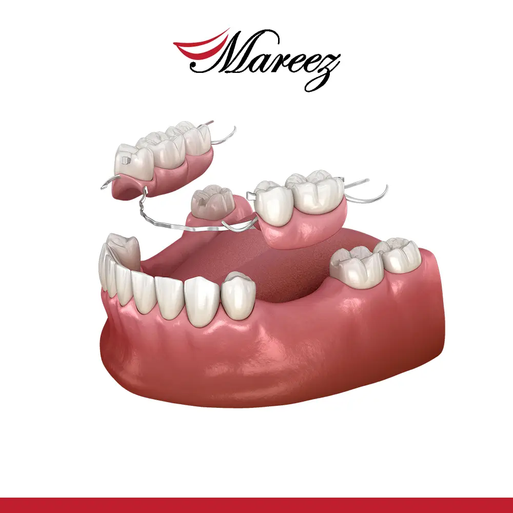 تركيب سن واحد متحرك أفضل عيادة لتركيبات الأسنان المتحركة في جدة