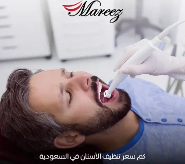 كم سعر تنظيف الأسنان في السعودية