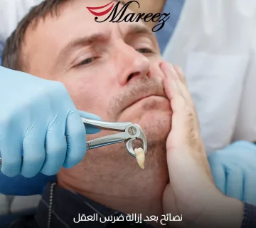 نصائح بعد إزالة ضرس العقل