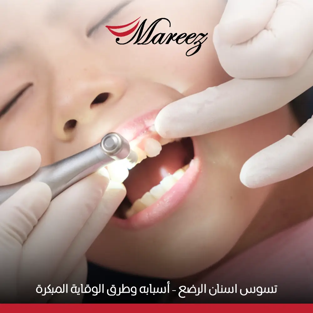 تسوس اسنان الرضع​